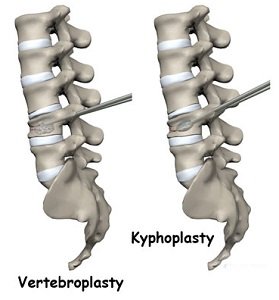 kyphoplasty-and-vertebroplasty